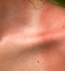 피부암 초기증상 12