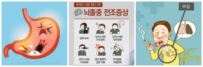 위암, 뇌졸중, 폐암 사진