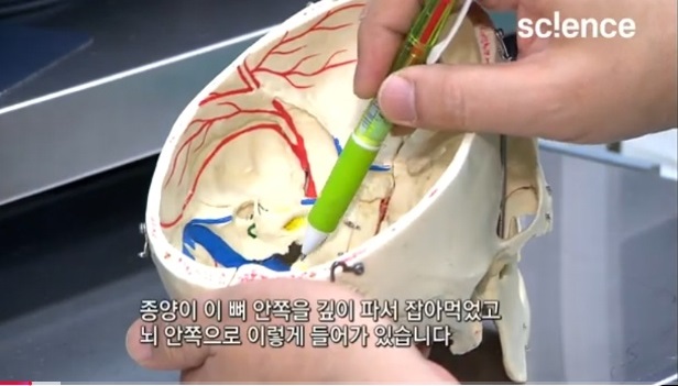 뇌종양명의