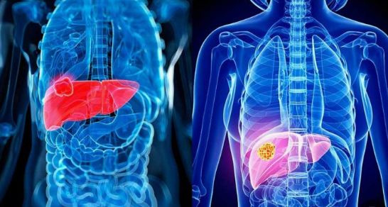 간 수치 검사의 정상 범위와 낮거나 높으면 그 의미와 증상