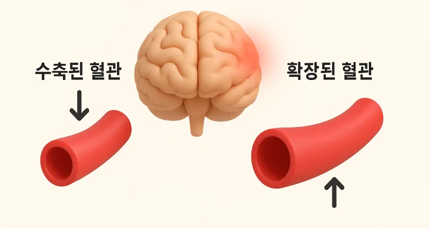 편두통 원인