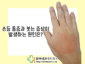 손등 붓는 이유 혈액순환 문제 증상과 해결법 정리_5