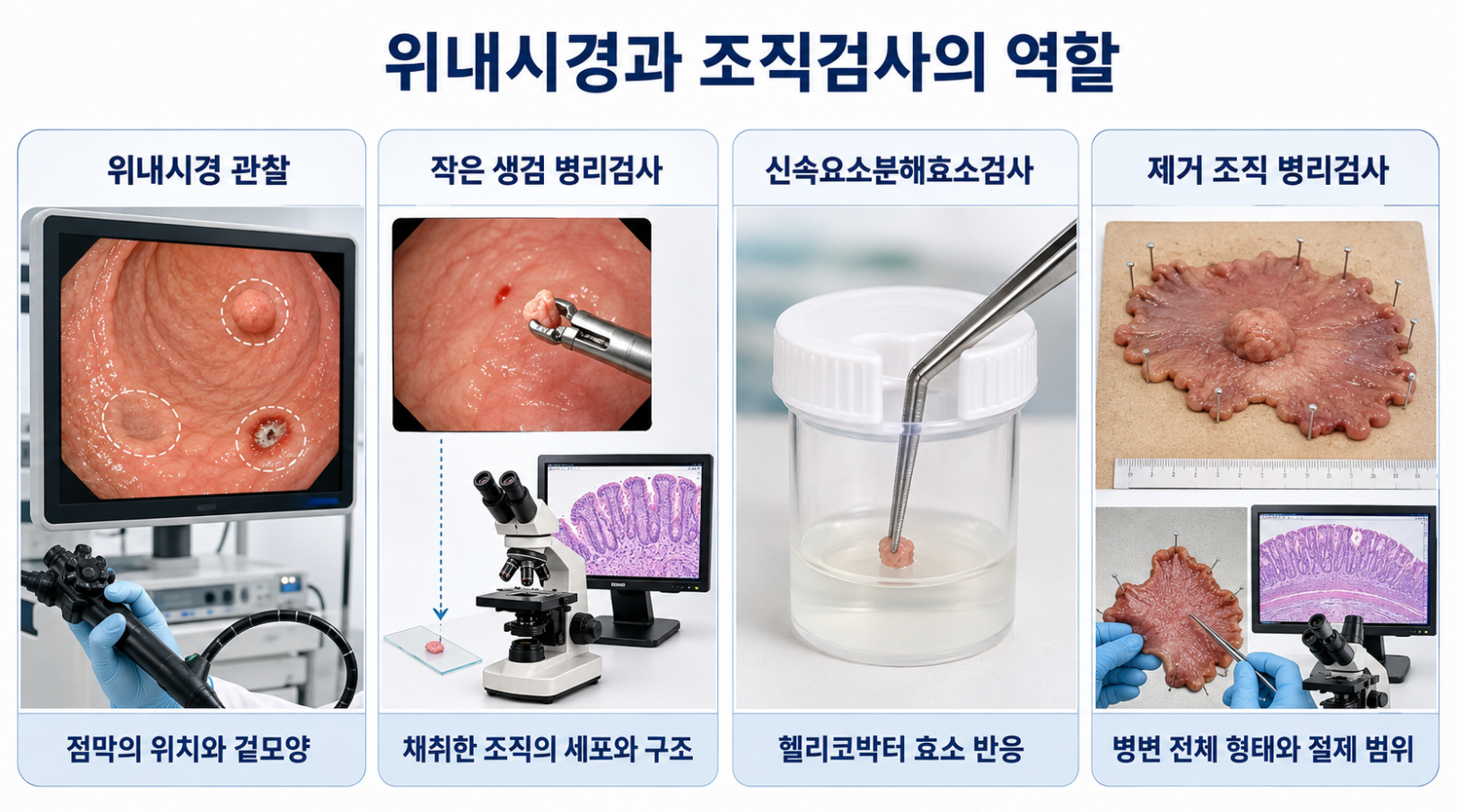 위내시경 관찰과 작은 생검 병리검사 신속요소분해효소검사 제거 조직 병리검사 비교