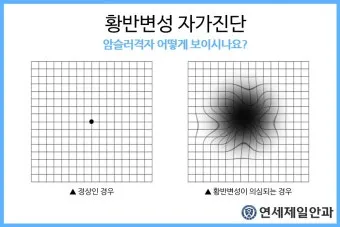 시야에 검은점 시야에 까만점이 보일때 원인과 대처법_4