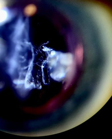 비문증 증상 2가지