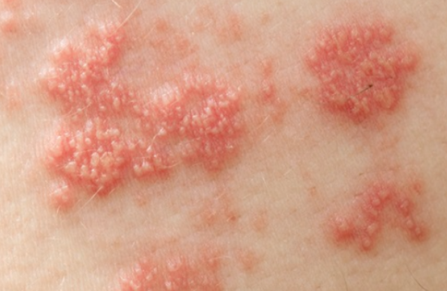 대상포진의 진단