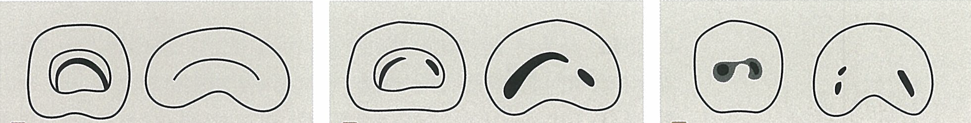 c-canal 치아 근관의 세 가지 형태