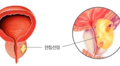 전립선암이미지