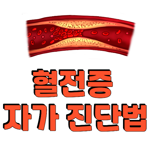 혈전증 자가진단법