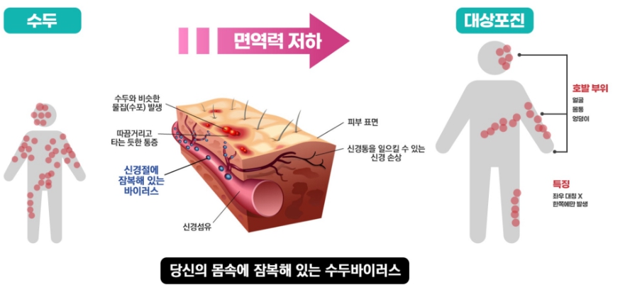 대상포진 발생 부위