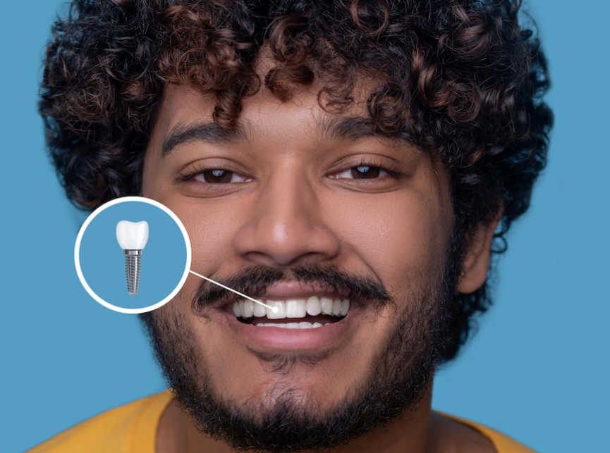 곱슬머리 남성이 임플란트 한 치아를 보여주고 웃고 있다.