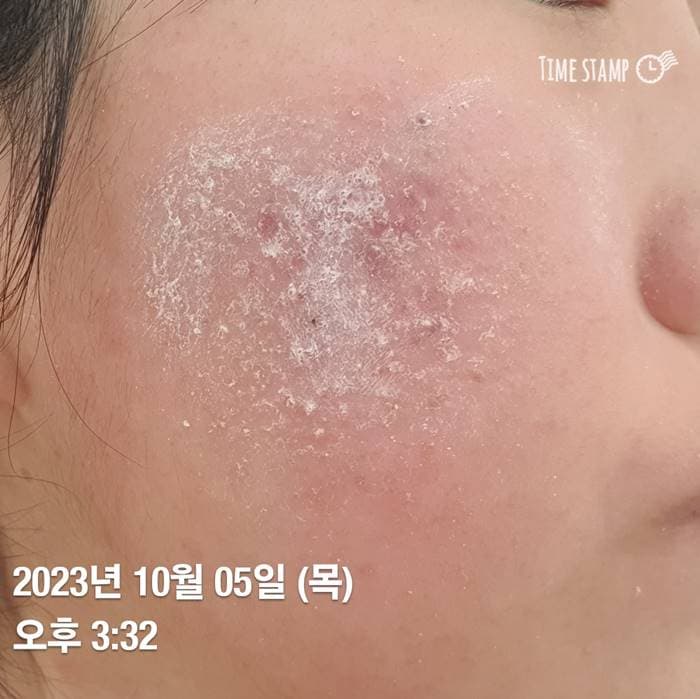 얼굴 피부염