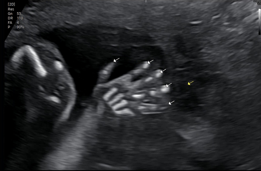 임신 중기 정밀초음파 보는 날 자궁수축