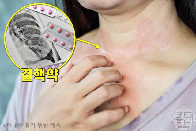 땀 건강 땀 색깔 증상,빨간땀 결핵,팁줌