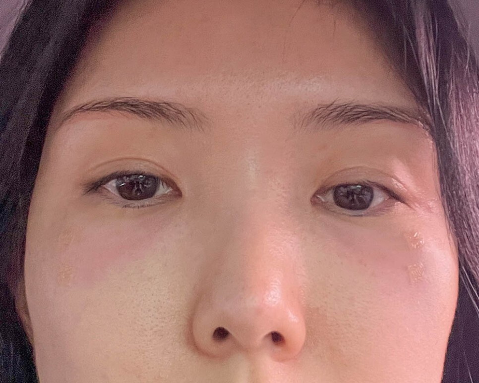 눈밑지방재배치 후기