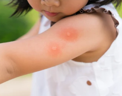 모기 알레기성 스키터증후군