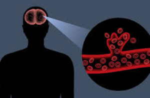 뇌동맥류 초기 증상