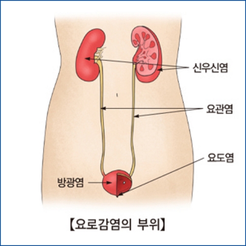 요로감염 부위
