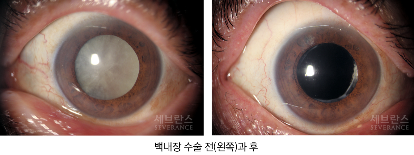 백내장