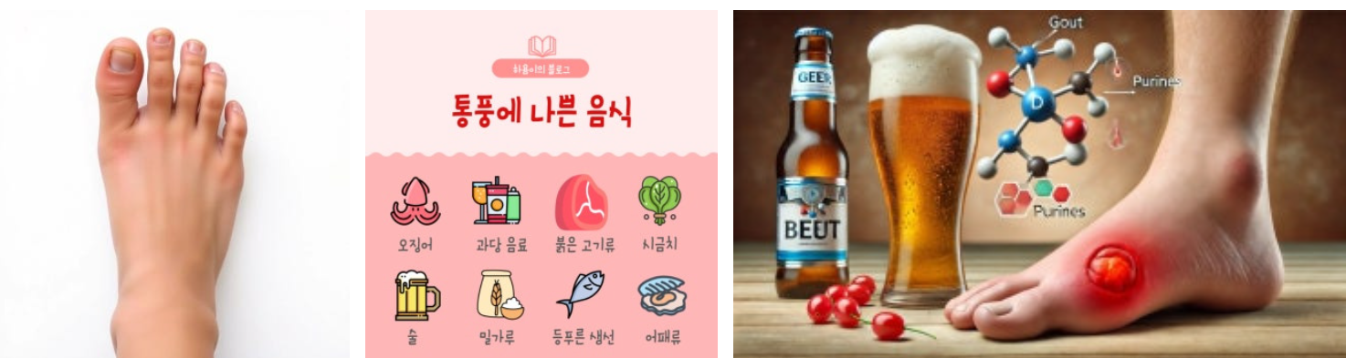 통풍을 예방하는 생활 습관