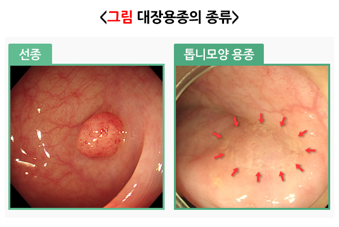 대장암 증상 총정리 : 1~3기 단계별 증상