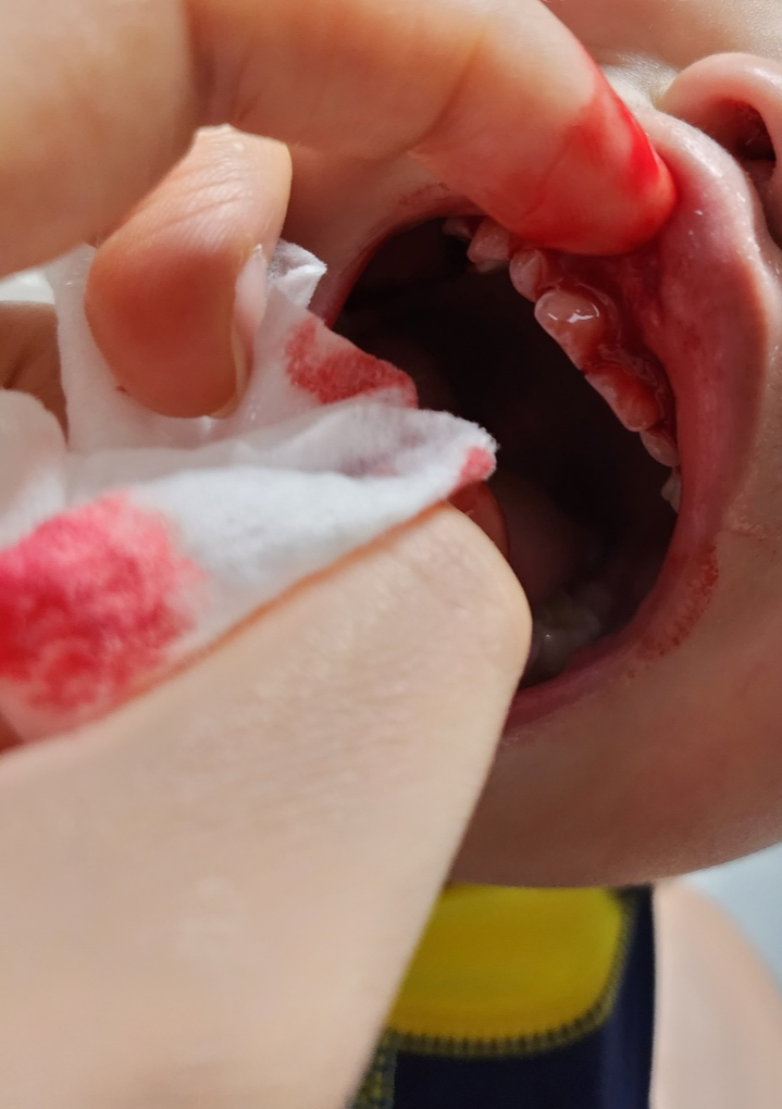 아이 입술찢어짐 입술순소대 찢어졌을때