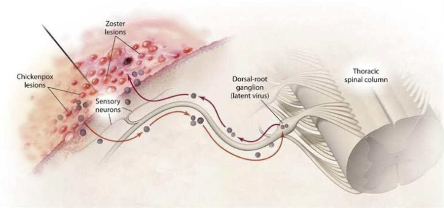대상포진 초기증상