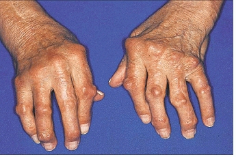 초기 증상 10가지 - 류마티스 결절, MSD매뉴얼 참조