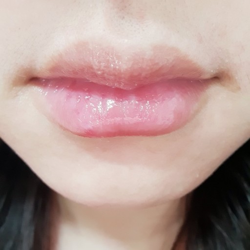 입술이 붓는 이유