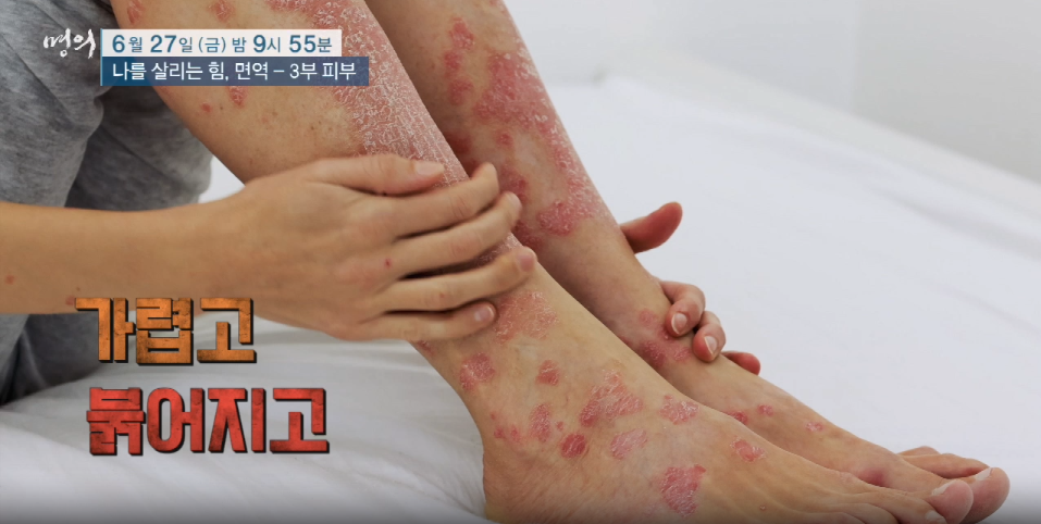 명의 나를살리는 힘 면역 3부 피부