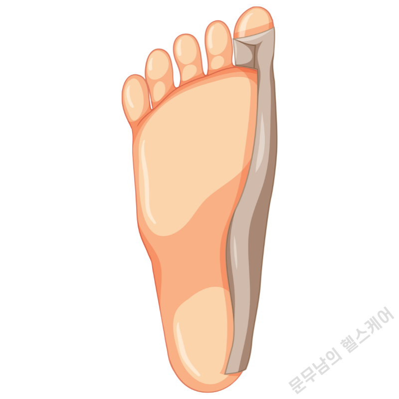 엄지발가락 옆 통증 원인 무지외반증