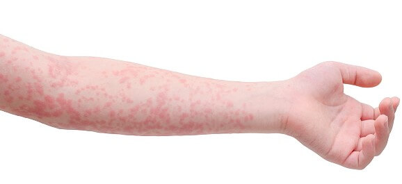 성홍열로 인한 피부 발진