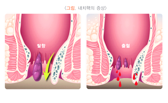 내치핵의 증상