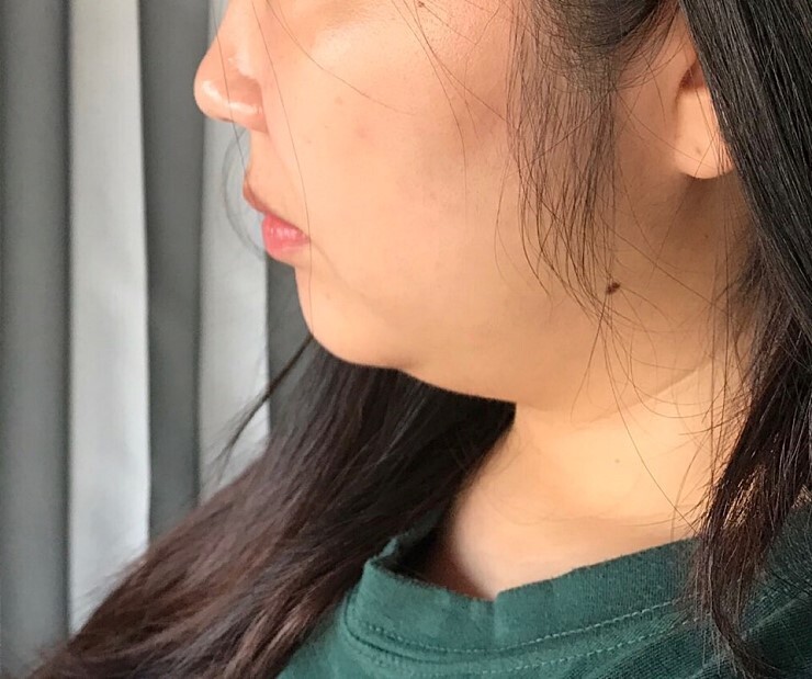 턱살지방흡입 후기