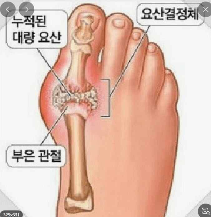 재발성 통풍 초기증상및 치료