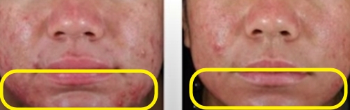 아클리프-4세대