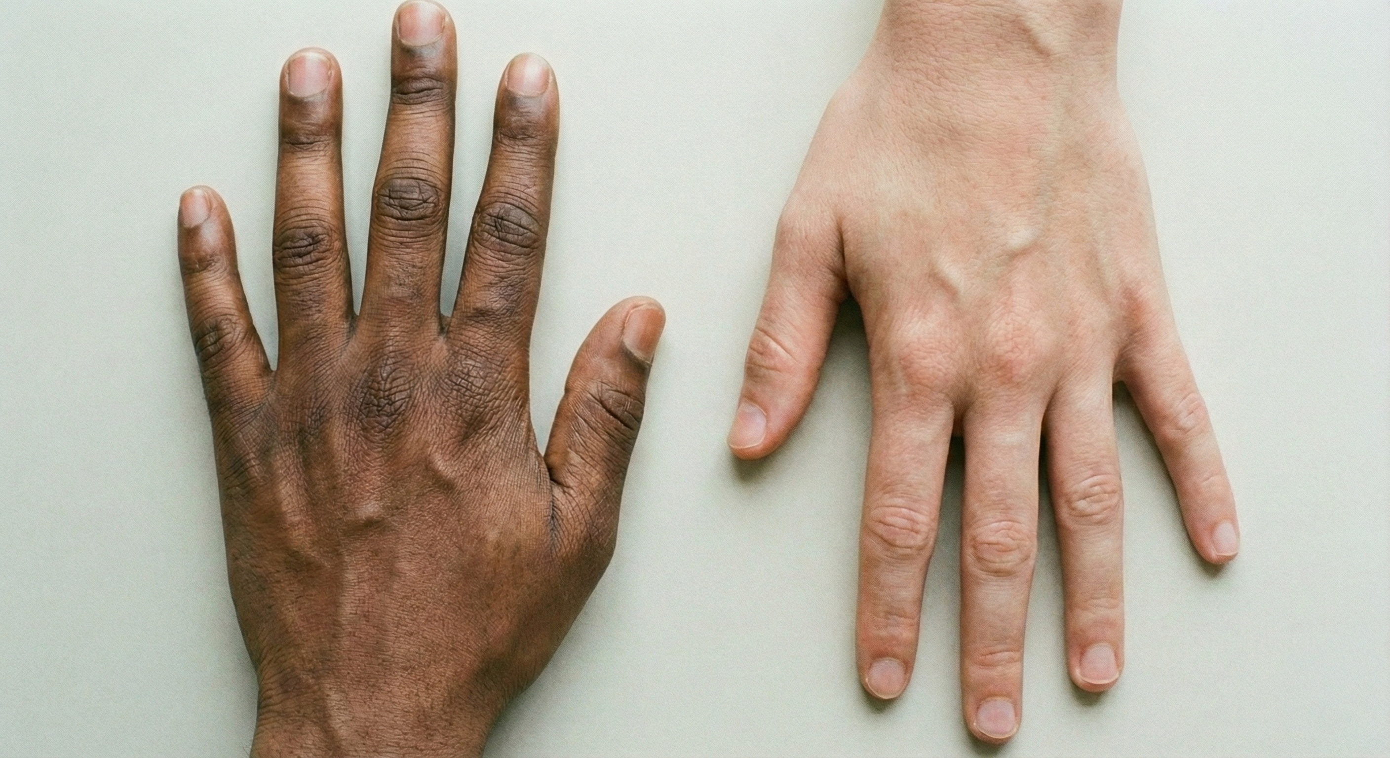 애디슨병 초기증상