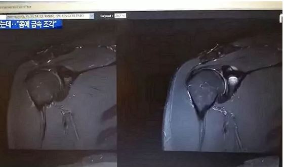 최지현 경사 장애