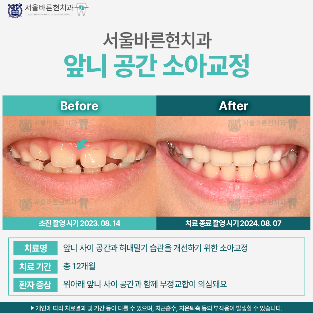 부산마린시티소아교정
