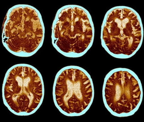 알츠하이머 초기증상 4가지와 대처방법 알아보기