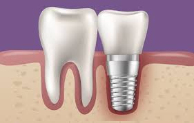 임플란트와 틀니 유지 관리