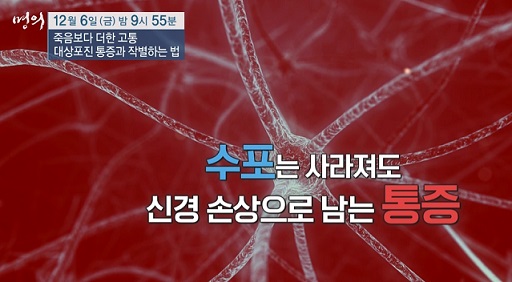 대상포진후신경통