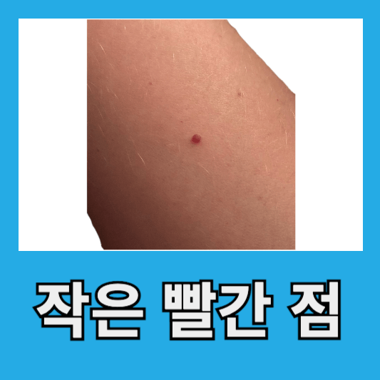 "팔에 작은 빨간 점"