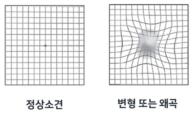 황반변성 증상 치료법 자가진단 원인 