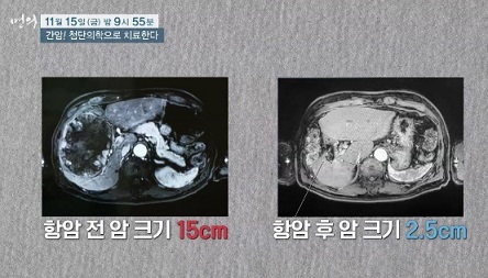 간암항암