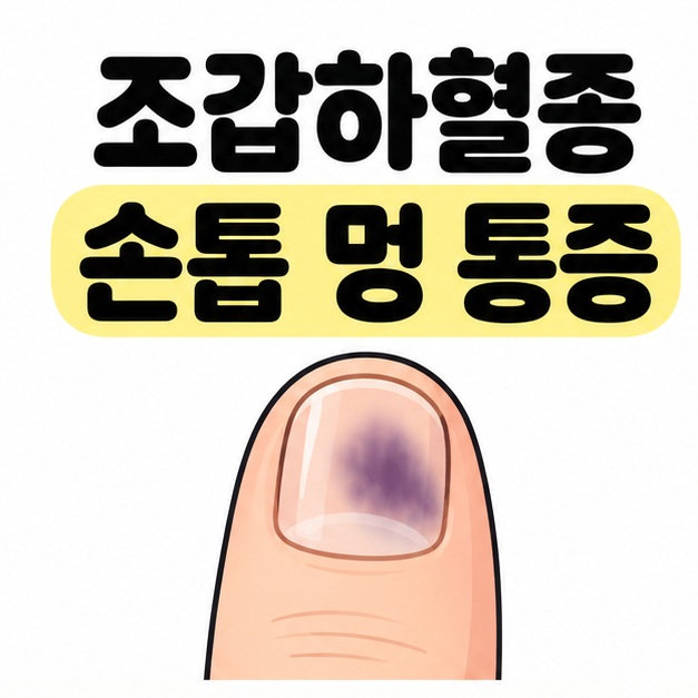 조갑하혈종 손톱 멍 통증 제목 아래 손톱 안에 보랏빛 멍이 있는 손끝을 배치한 대표 그림