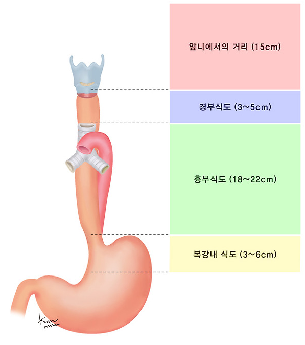 식도암의 원인과 증상, 진단, 치료와 예방 방법, 합병증