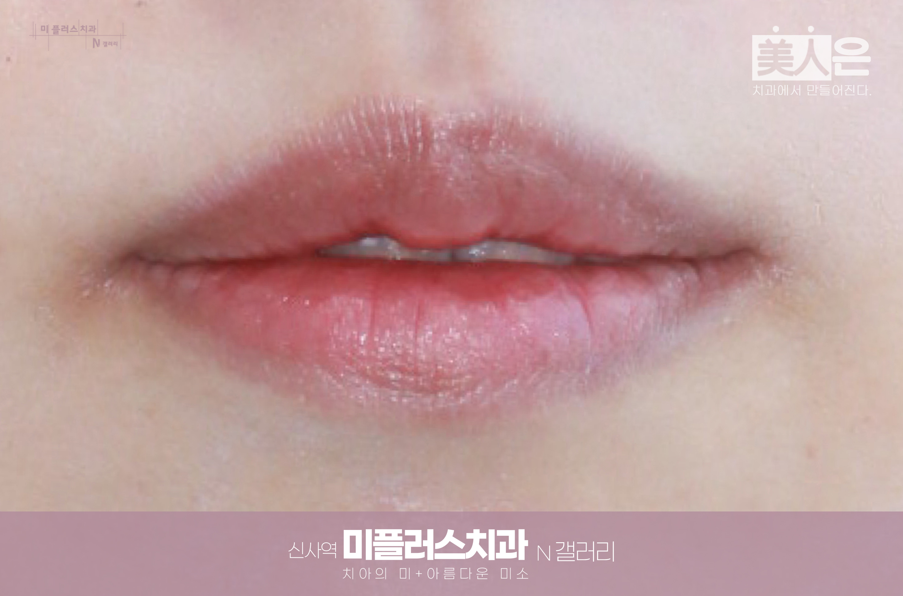 자연스럽게 균형 잡힌 입꼬리와 편안한 무표정의 입매