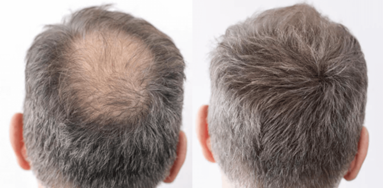 정수리 탈모 치료