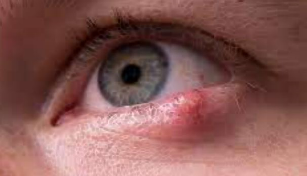 다래끼 빨리 낫는법